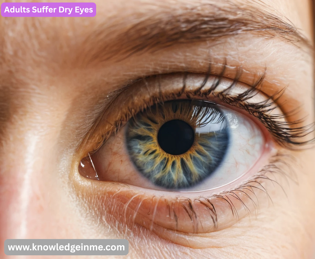 Adults Suffer Dry Eyes